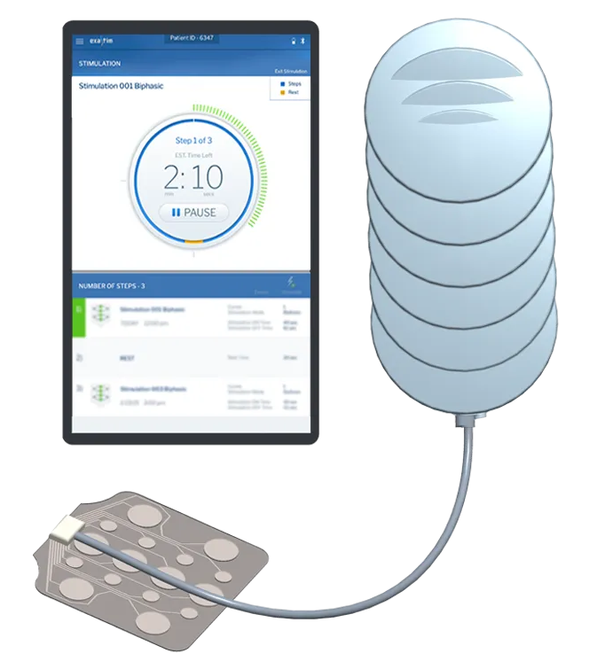 4_1_2_1_1_Aneuvo_Trans_Spinal_Stimulation (TSS)_Spinal Cord Stimulation (SCS)