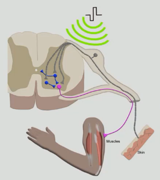 Trans_Spinal_Stimulation_Transcutaneous_Stimulation_3