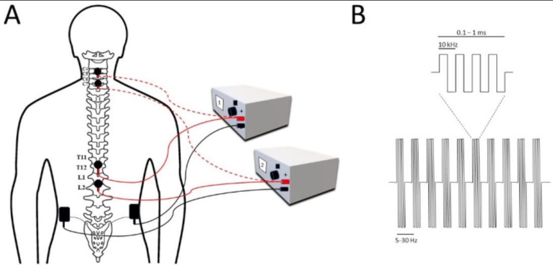 Trans_Spinal_Stimulation_Transcutaneous_Stimulation_2